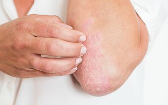 Psoriasis is accompanied by constant itching. 