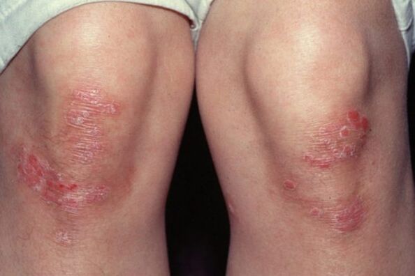 knee psoriasis