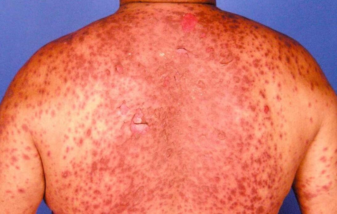 psoriatic erythroderma on the back