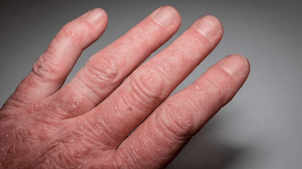 psoriatic arthritis in the hands