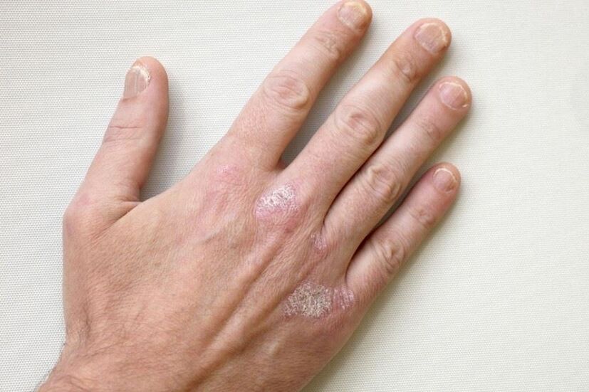 An obligatory symptom of psoriasis is scaly plaques on the skin. 