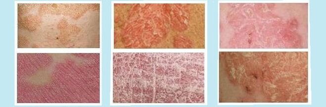 Skin rashes characteristic of different types of psoriasis. 