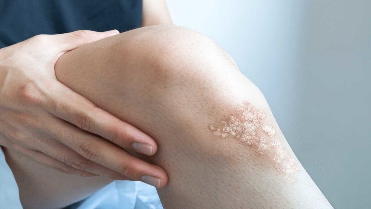 Manifestations of psoriasis on the knees. 