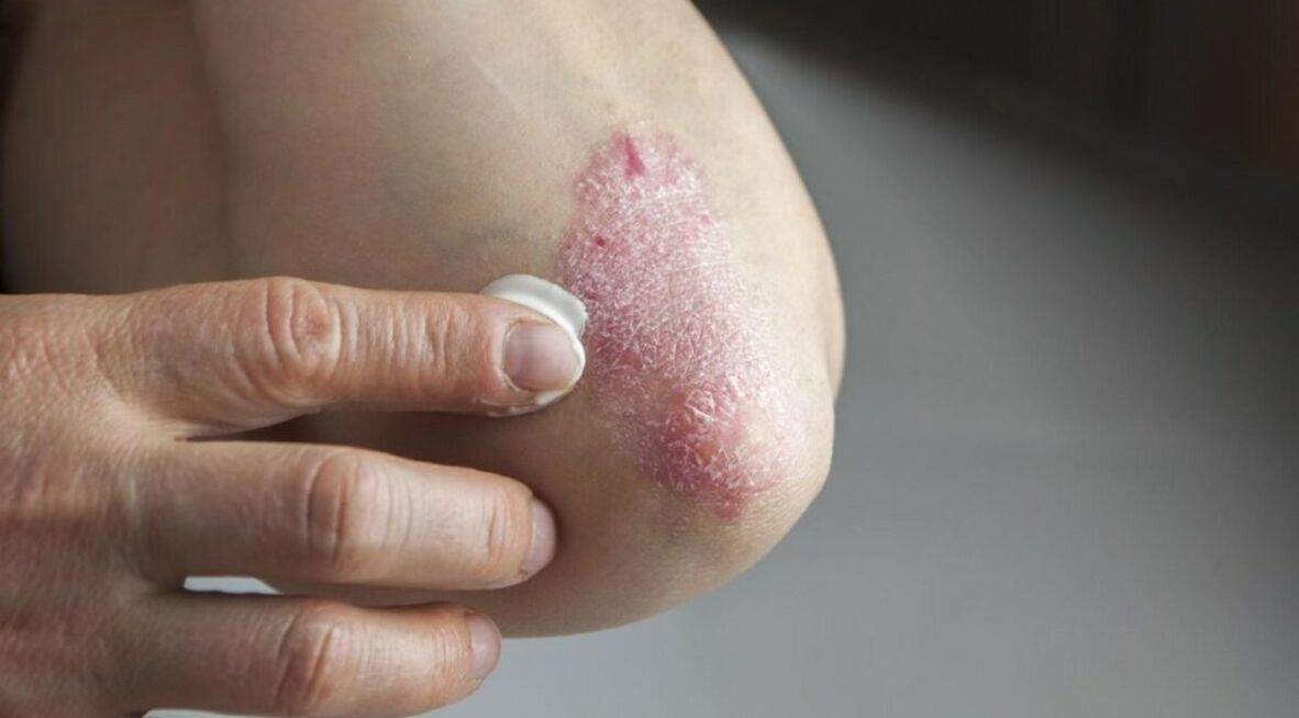 Psoriasis that affects the skin, whose treatment includes the use of ointments. 