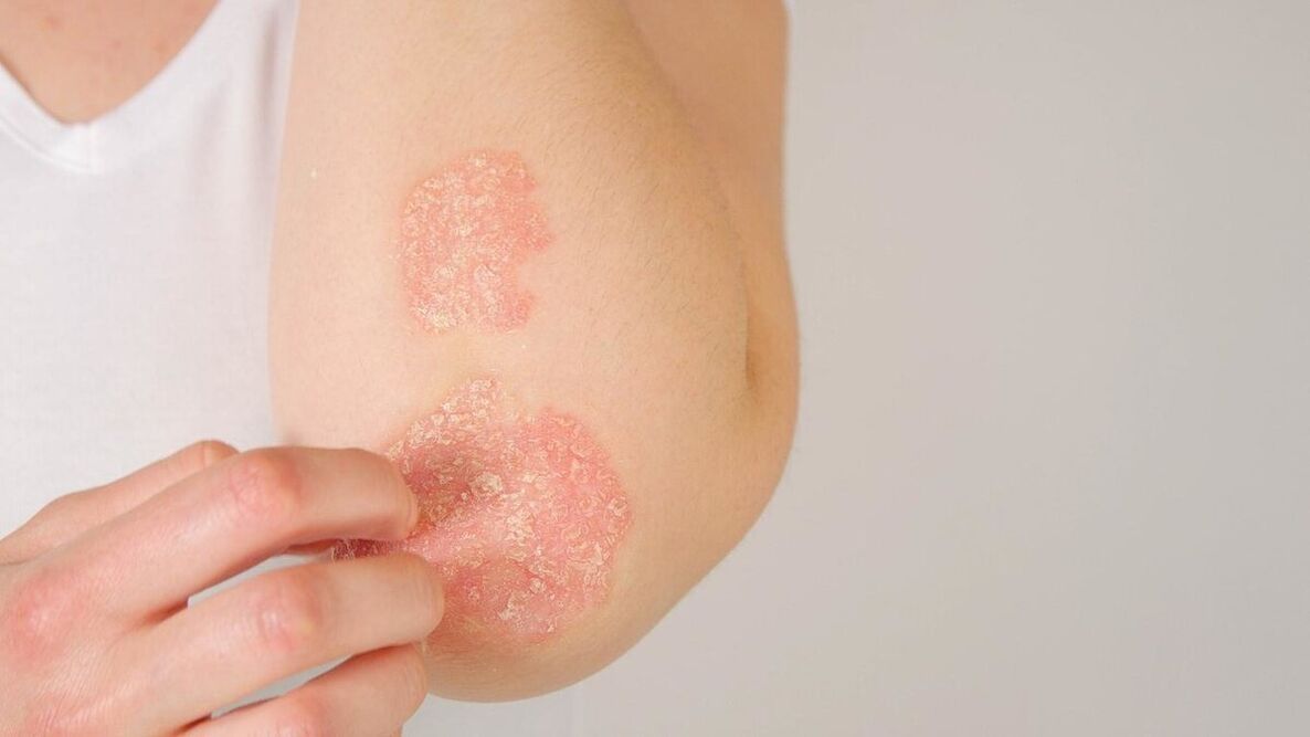 Psoriatic plaques on the elbows. 