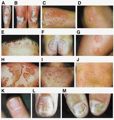 Signs of psoriasis depending on the type of disease. 