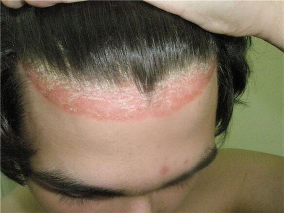 Manifestations of psoriasis of the scalp. 