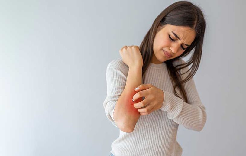 Psoriasis manifests itself as skin rashes and itching. 