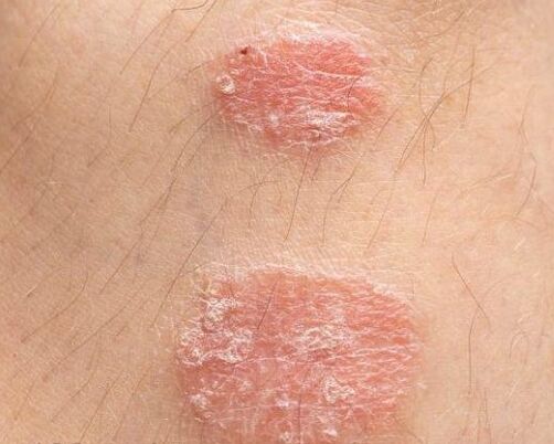 Appearance of psoriatic plates