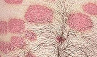 Multiple rose formations in the abdomen