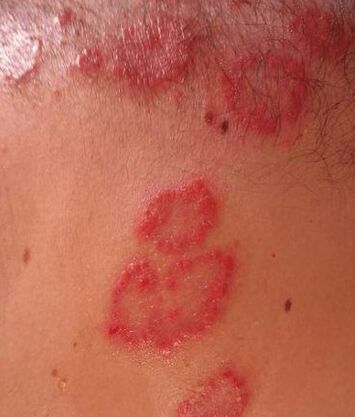 Psoriasis spots
