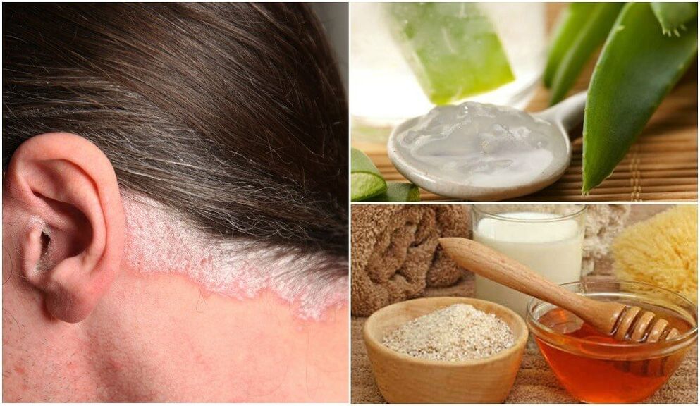 Treatment of psoriasis with popular remedies