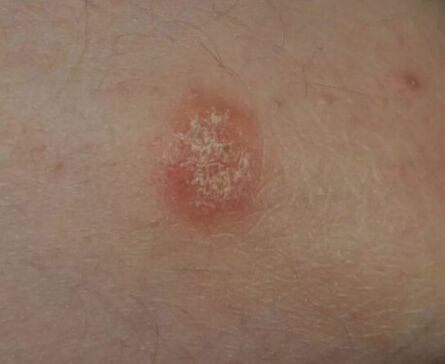 Place of psoriasis