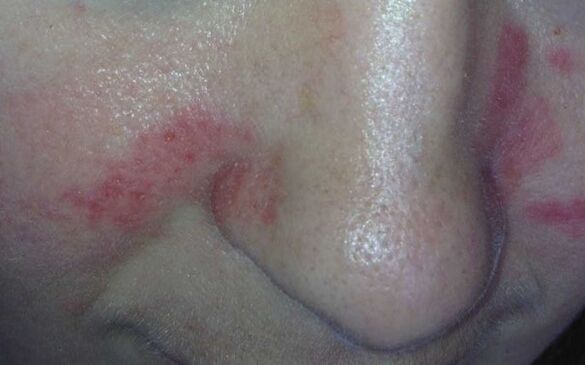 Psoriasis symptoms on the face