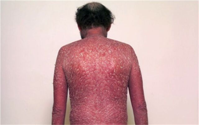 The third stage of psoriasis