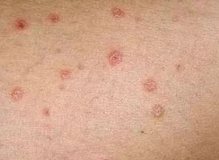 Psoriasis of the initial stage
