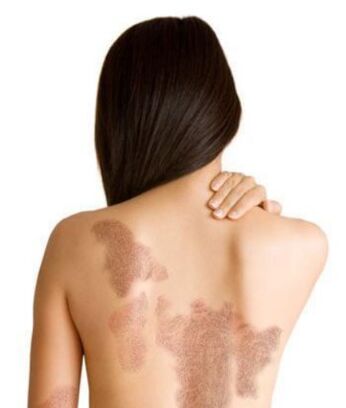 Stages of psoriasis depending on the area of ​​injury