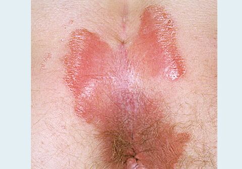 Psoriasis of near change