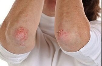 Psoriasis in the elbows