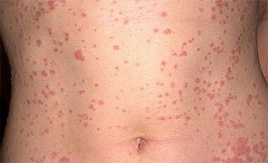 Psoriasis in the body