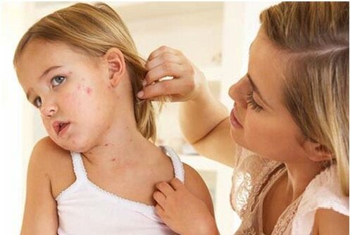 Photo of the initial stage of psoriasis