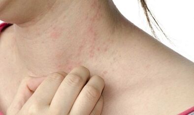 Treatment of psoriasis in advanced stage.
