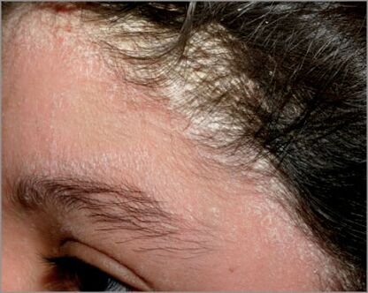 Damage to the scalp