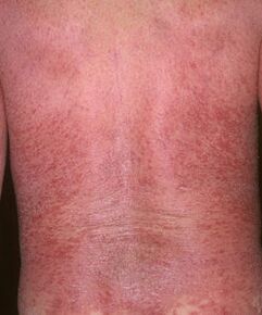 erythroderma