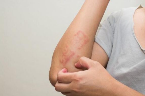 The latest methods to treat psoriasis