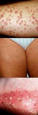 Leg psoriasis