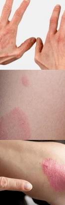 Psoriasis of the initial stage in the hands
