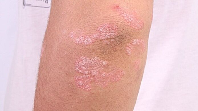 photo of psoriasis in early stage