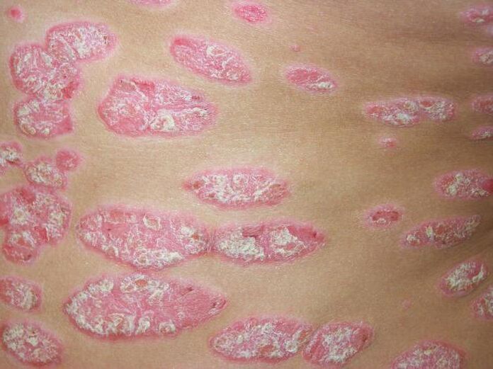 plaque psoriasis