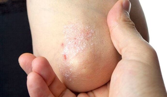 psoriasis symptoms in the initial stage