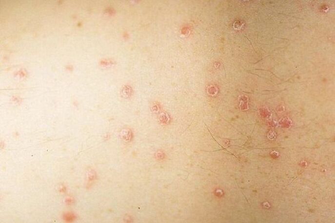 symptoms of localized psoriasis