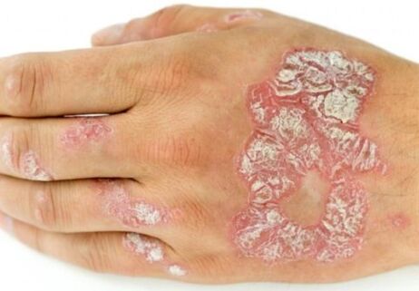 psoriasis on the hand