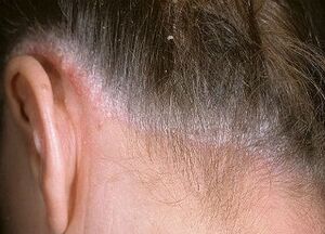 causes of psoriasis on the head