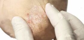 Psoriasis in attenuation stage