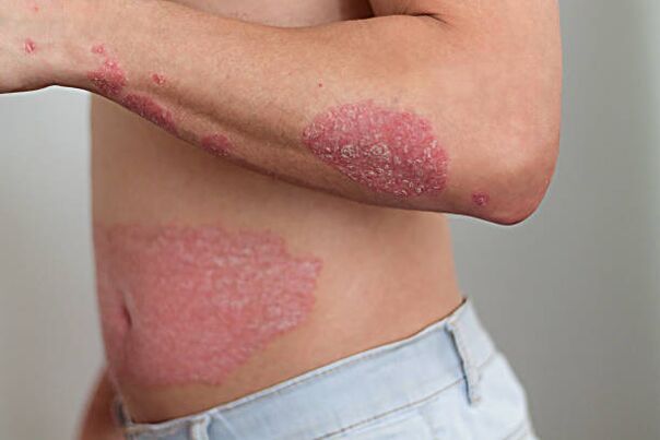 psoriasis on the body of a man