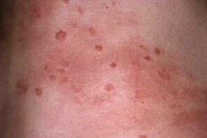skin psoriasis photo